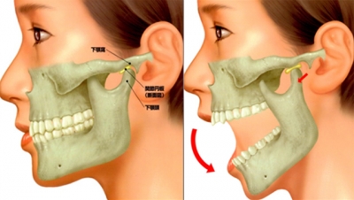 カラダカイロ　顎関節症　図